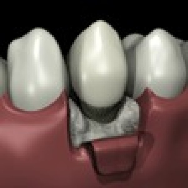 Etape 5 : La chirurgie parodontale