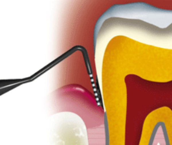 Etape 3 : le surfaçage et la lithotritie parodontale